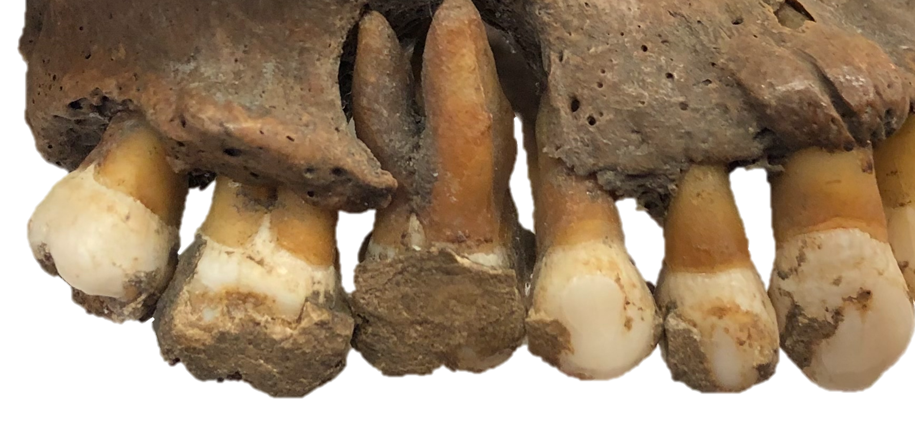 Real archaeological human maxilla with calcified dental plaque on molars and a periapical lesion, from a Tlatelolco archaeological burial in Mexico, photographed by Kelly Blevins. No biomolecular results are inferred from the photo.